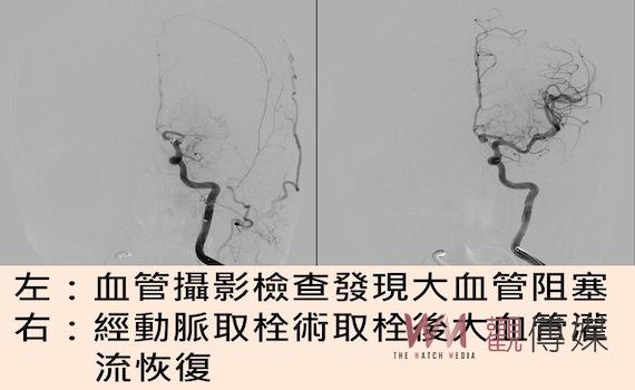 大血管中風治療黃金期 「動脈內機械取栓術」延長搶命時間