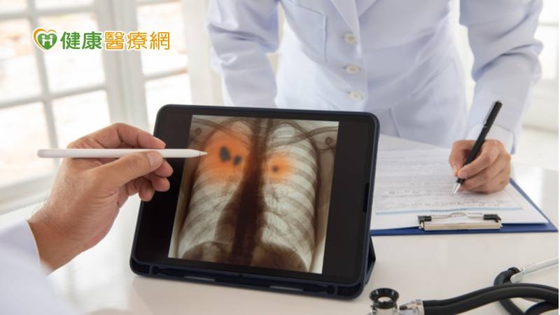 領先國際! 臺灣7月啟動LDCT肺癌篩檢