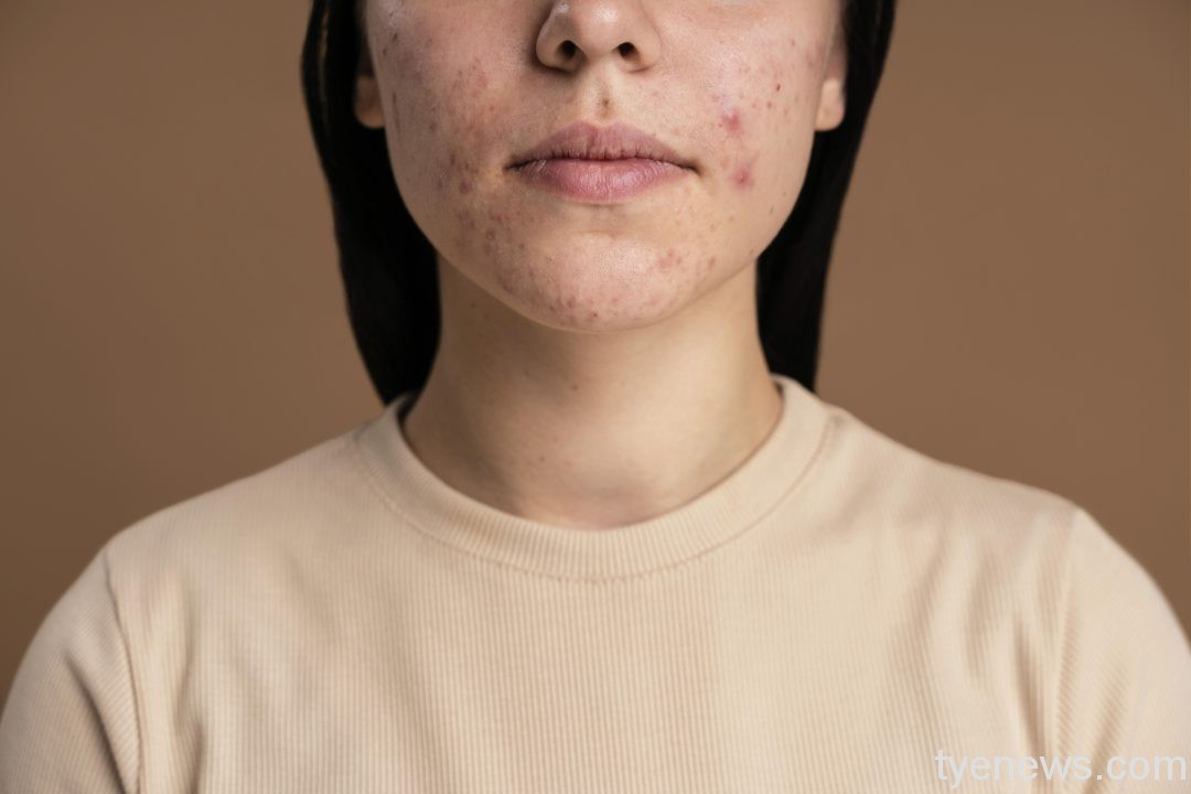「看臉時代」想擺脫外貌焦慮?桃園張老師提供妙招 21 confident young woman with acne close up