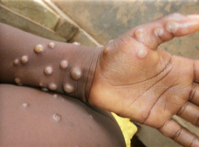 非洲流行病猴痘（Monkeypox）近期已逐漸擴大至歐洲及北美國家。資料照。（圖／翻攝世衛官網）