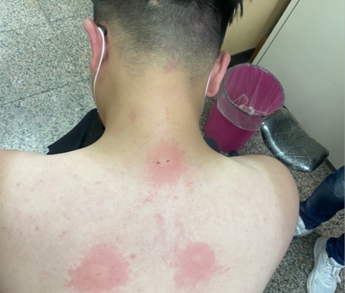 ▲警方搜山行動中,有員警遭竄出虎頭蜂攻擊螫傷,所幸緊急救治後已無大礙 (圖/台中市警察局 提供)