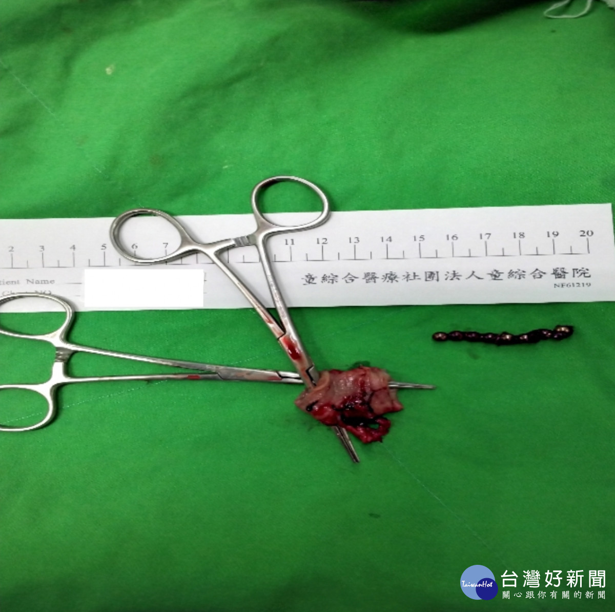 手術取出的小腸與8顆巴克球。