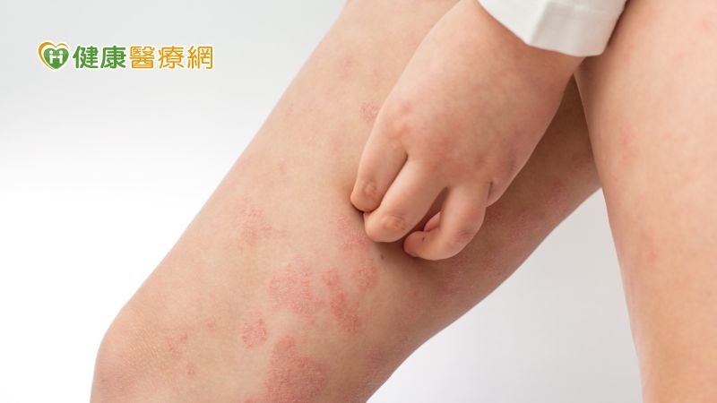皮膚反覆濕疹,內服外用都治不好,竟是「惡性皮膚T細胞淋巴瘤」