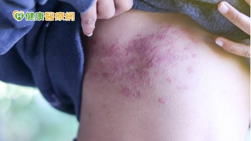 器官移植患者多留心 感染帶狀疱疹風險高