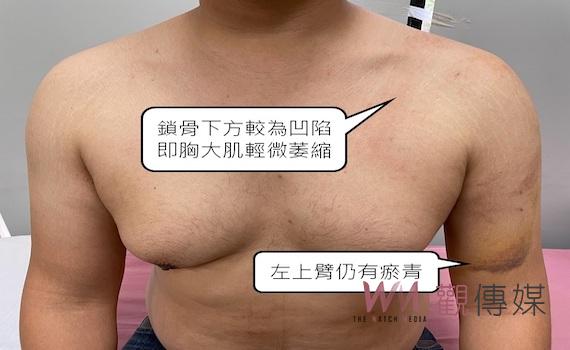 壯男健身「胸大肌」突斷裂    醫師：重訓要量力而為