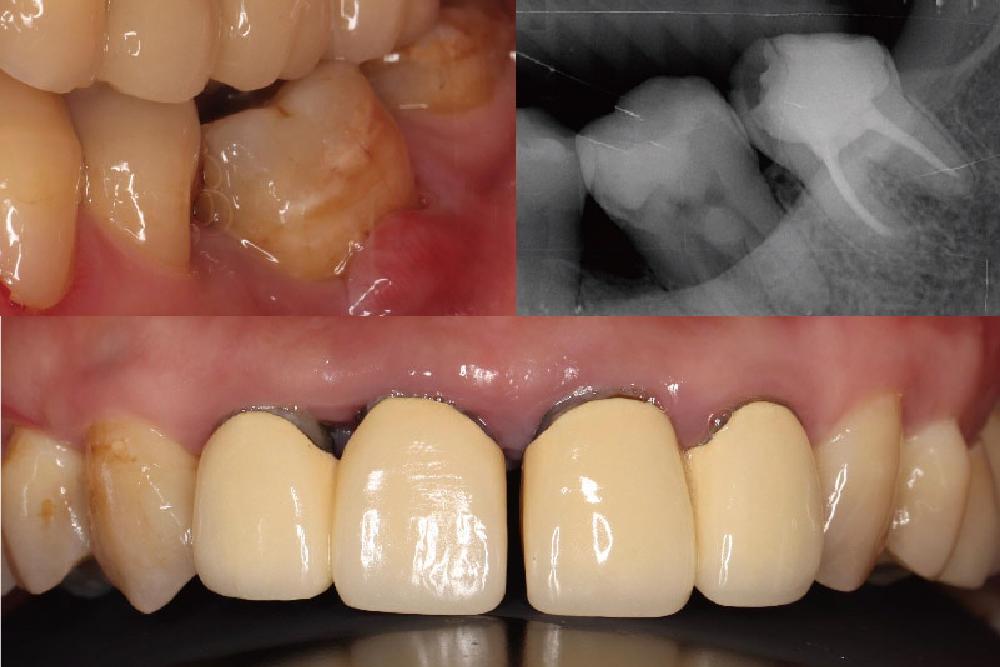 【有影】假牙縫隙越來越大?小心嚴重牙周病找上門 20 匯流新聞網CNEWS資料照片124220817a01