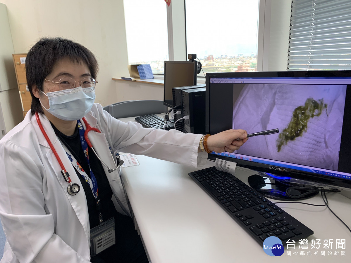 高佳慧醫師筆指處即為感染沙門氏桿菌腸胃炎病童的糞便,多為黏液狀糊狀,也可能出現血絲便。