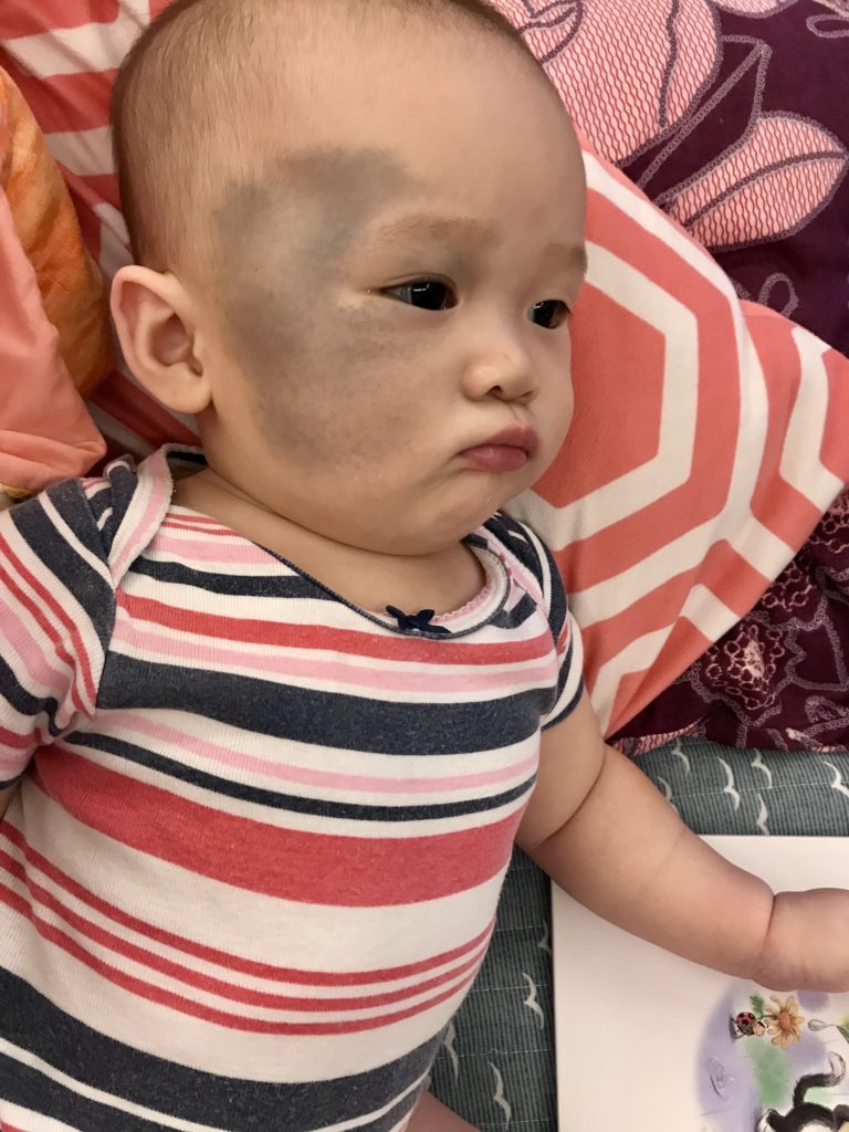 小霏出生臉上就有明顯太田母斑。