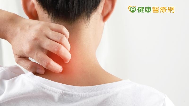 拚工作賠了健康!頸背發炎脫皮流血 連吞6顆類固醇都壓不住