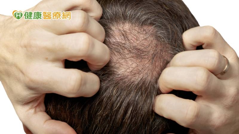 頭頂大危機! 生髮帽真的有效嗎?