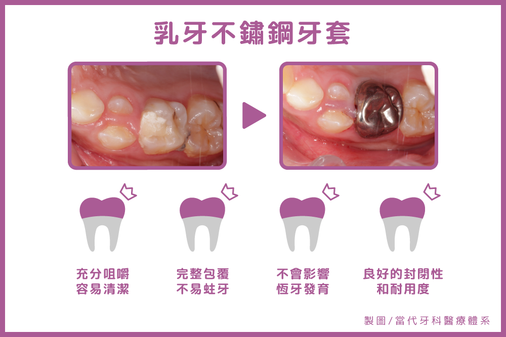 【有影】為孩子乳牙戴上頭盔!小鋼牙提供乳牙治療周全保護 22 新增專案 2022 09 19T152904.452 1