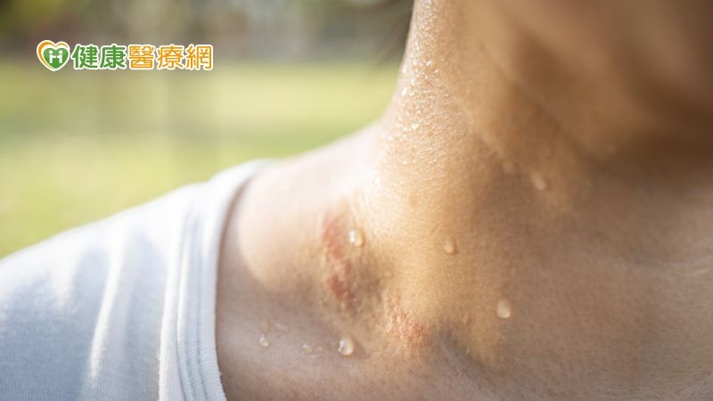 多汗、盜汗傻傻分不清? 美女中醫師分析報你知