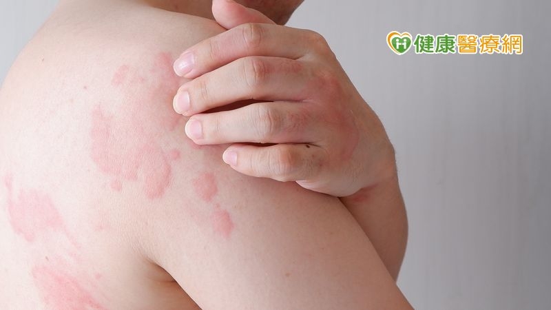 蕁麻疹發作癢到睡不著 中醫調整體內陰陽治癢