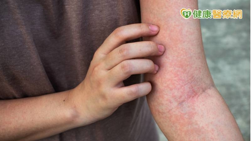 女大生打完新冠疫苗嚴重藥物疹 免疫抑制劑成功治療