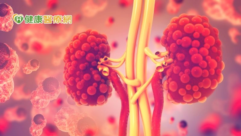 多囊腎易誘發高血壓與泌尿道結石 併發症未妥善控制恐加速洗腎
