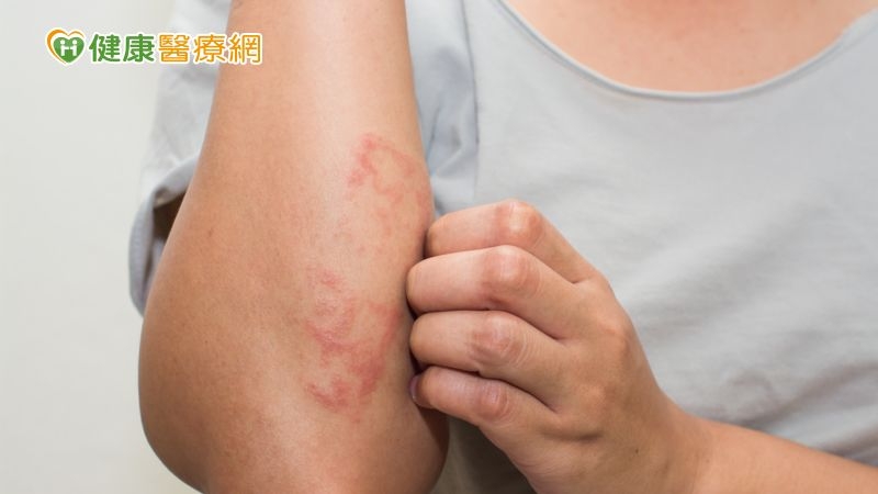 癢到受不了!異位性皮膚炎愈早開始治療愈好!!