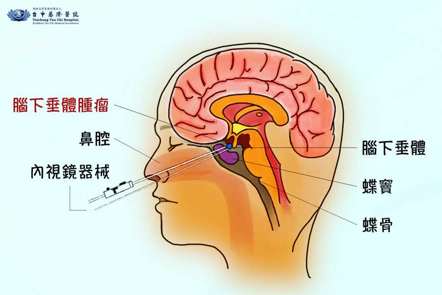 腦下垂體瘤手術示意圖