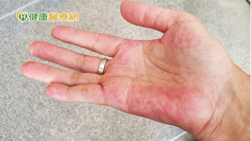 大林慈院為紅斑性狼瘡開創 「系統性整合照護模式」獲SNQ認證