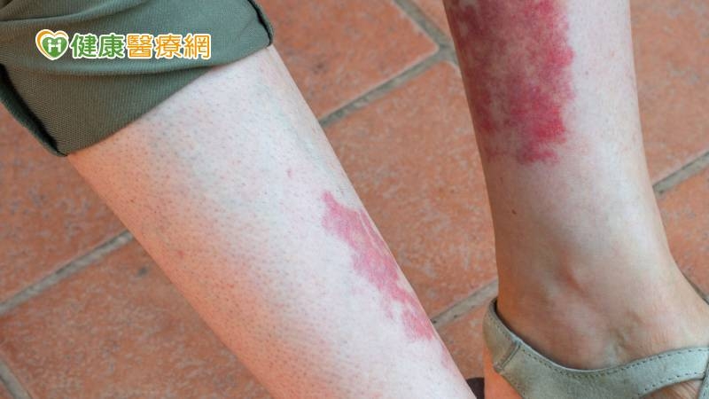 中年男突然肢體癱瘓 竟是過敏「血管炎」