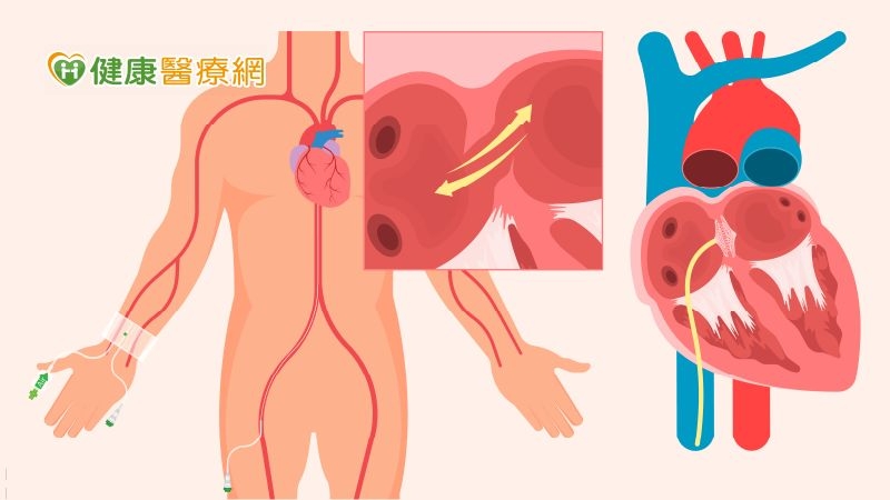 三成中風患者恐二度中風!不明原因中風需警覺 恐為卵圓孔未閉合