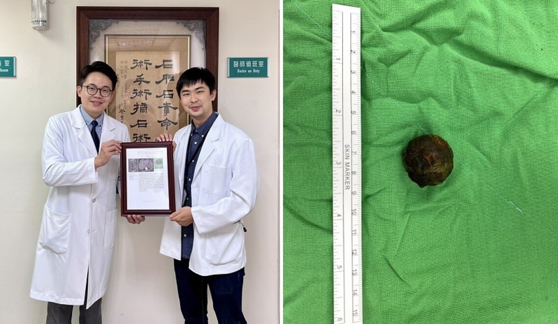 老婦膽結石跑進腸胃造成阻塞  發生率僅0.3%　高醫投稿榮登國際頂尖醫學期刊