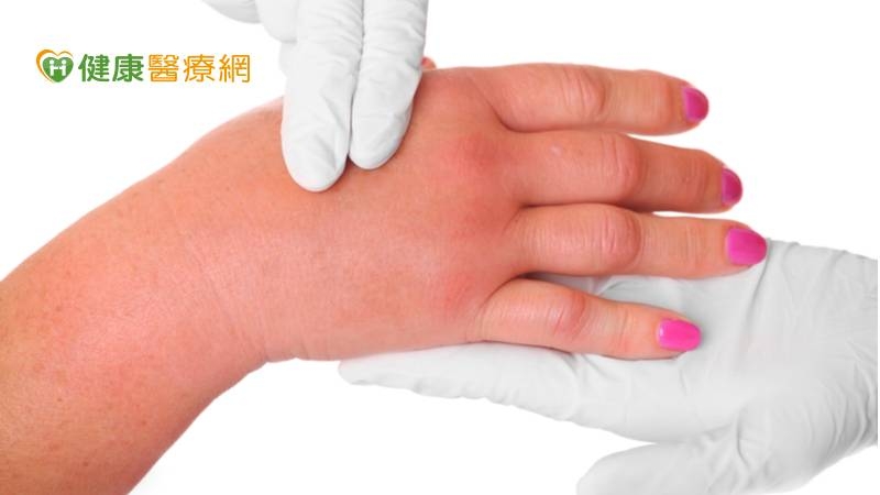 料理海鮮小心被刺傷 手腫脹險喪命 原來是「這細菌」感染
