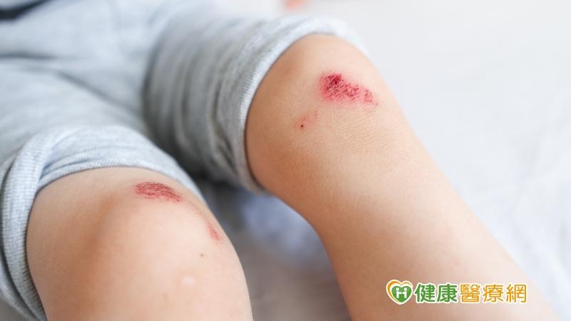 1歲童抓癢破皮滲組織液 母擦花露水恐讓發炎惡化