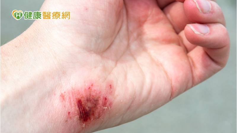 處理海鮮被刺傷 中年男「壞死性筋膜炎」險致命