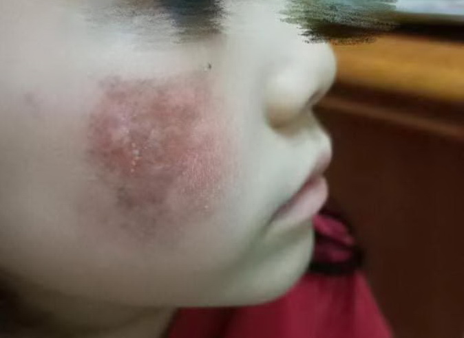 就讀私立佳佳示範幼兒園遭幼教師菜瓜布重刷,女童臉部紅腫破皮當晚返家被家長發現非常心疼。(圖/女童母姚姓新住民提供)