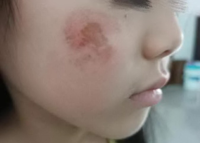 遭幼教師菜瓜布重刷,女童臉部第三天的情況仍明顯紅腫破皮。(圖/女童母姚姓新住民提供)