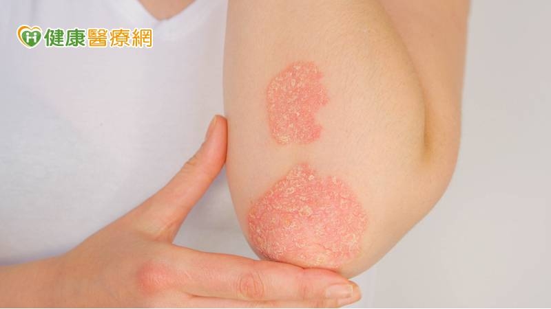 十餘年飽受乾癬折磨 「1療法」讓他已能穿短褲出門