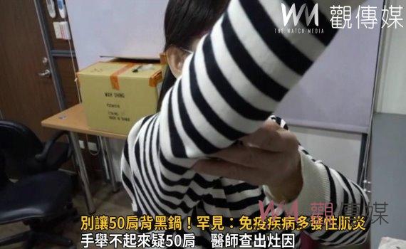影／別讓50肩背黑鍋！醫師查出灶因　罕見：免疫疾病多發性肌炎