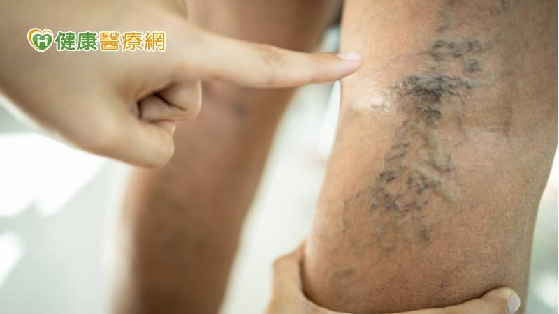 78歲嬤看電視坐整天 雙腿疼痛還大片瘀青