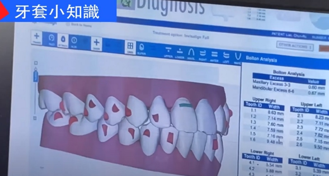 牙套小知識