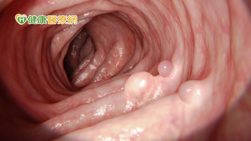 女星切除12顆大腸瘜肉,隔年又長6顆! 多久要做一次大腸鏡?