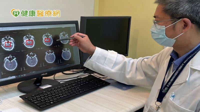 30秒內檢出顱內出血! 「AI偵測系統」爭取腦中風黃金治療期
