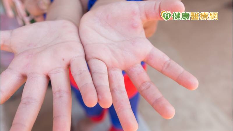 2021年來首見2例腸病毒併發重症！　疾管署揭「警覺病徵」快送大醫院
