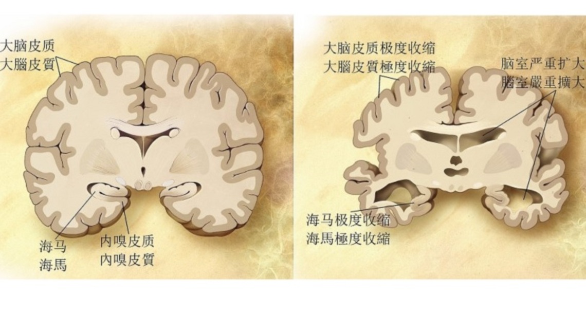 中國科學家找到可能觸發阿茲海默症記憶衰退機關