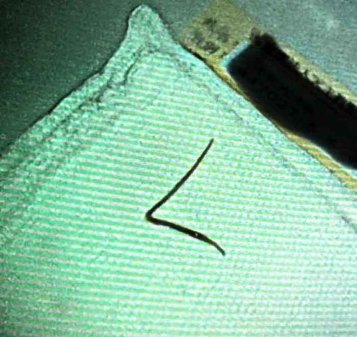 4公分魚刺竟卡大腸 差點造成腸穿孔