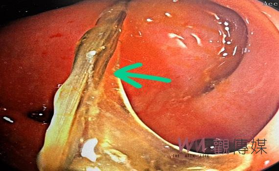 魚刺卡大腸險腸穿孔 聖馬爾定:年節大魚大肉要小心