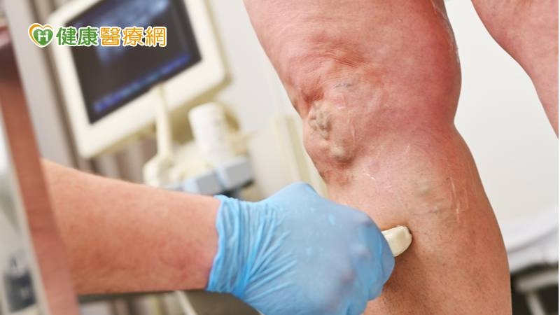 7旬翁左腳水腫、呼吸喘竟是深層靜脈拴塞! 噴泉抽吸雙導管解套