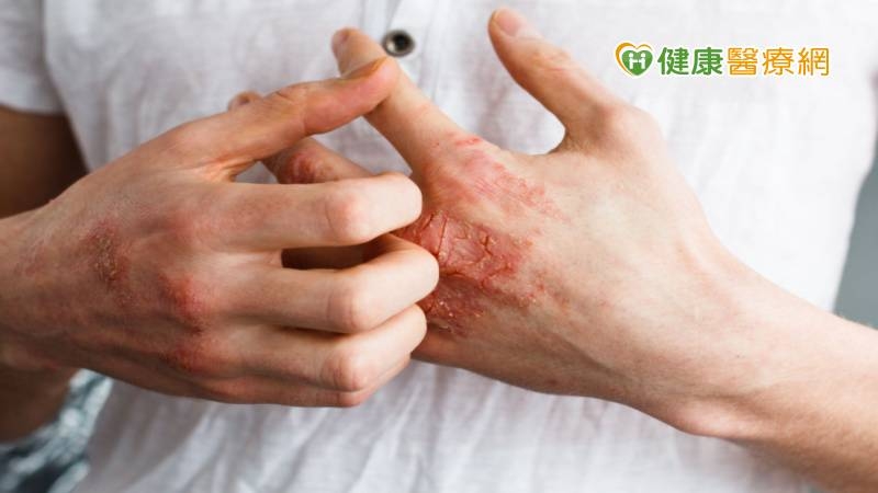皮膚癢狂抓恐誘發「冬季濕疹」！ 　醫授「日常保濕保養法」