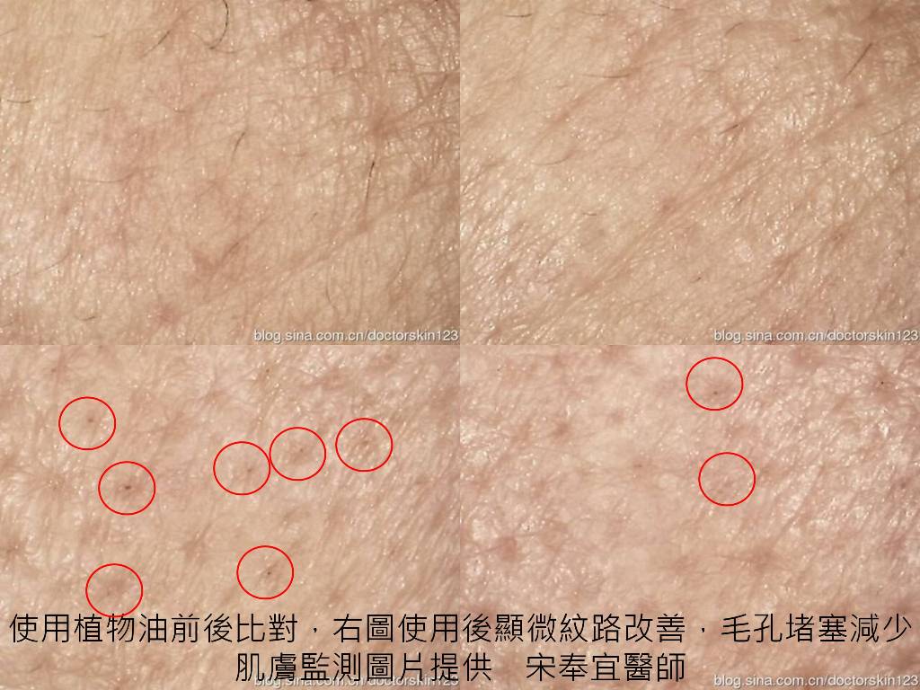 使用植物油前後比對,右圖使用後顯微紋路改善,毛孔堵塞減少 肌膚監測圖片提供 宋奉宜醫師