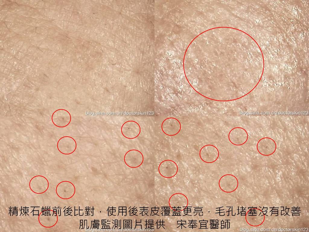 精煉石蠟前後比對,使用後表皮覆蓋更亮,毛孔堵塞沒有改善 肌膚監測圖片提供 宋奉宜醫師