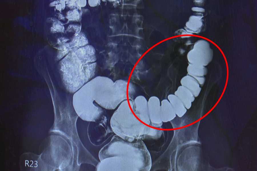 邱建銘主任從大腸攝影檢查發現，江小姐腸子繃得非常緊。（影片截取）