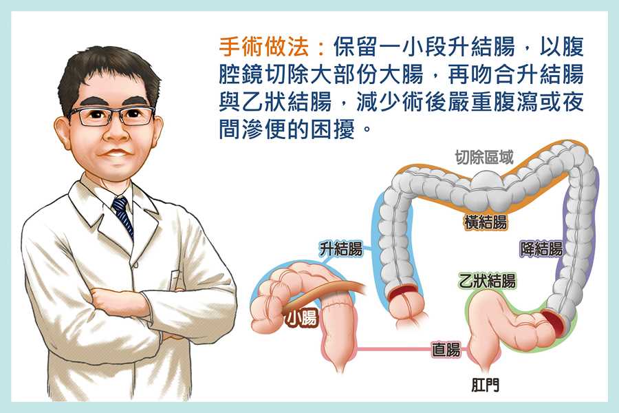 邱建銘主任保留病人一小段升結腸，切除大部份大腸，再吻合升結腸與乙狀結腸。（卓冠伶、陳彥儒製圖）