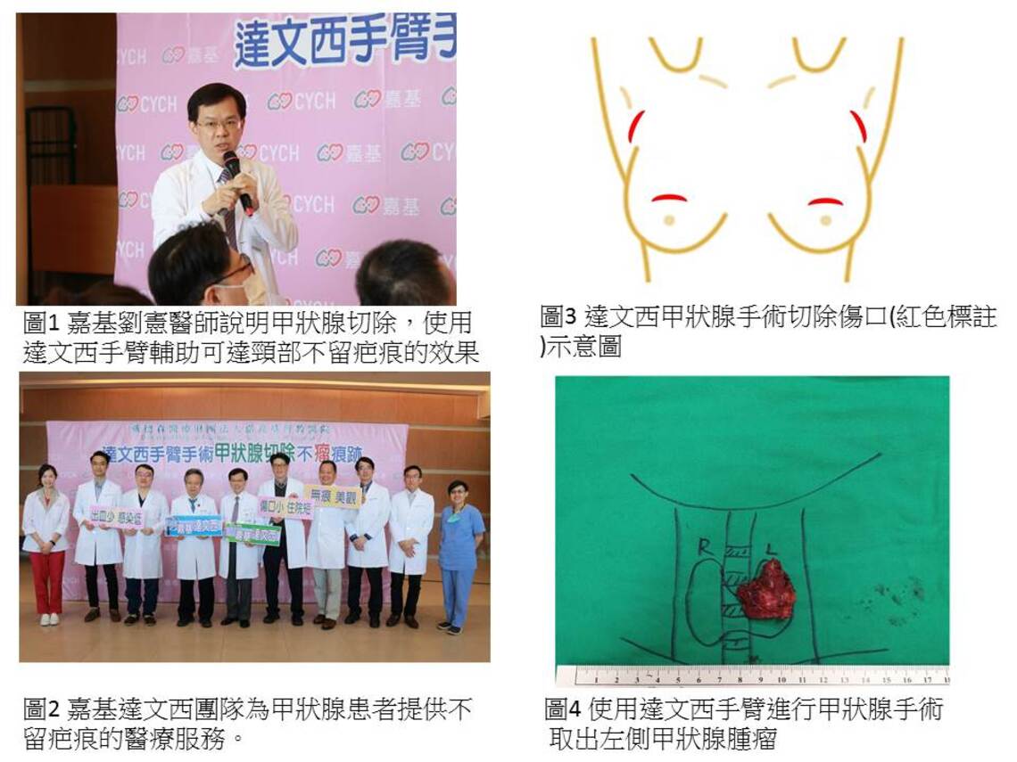 刪疤(三月八日)婦女節 摘下女王的項鍊甲狀腺切除 嘉基達文西 不「瘤」痕跡