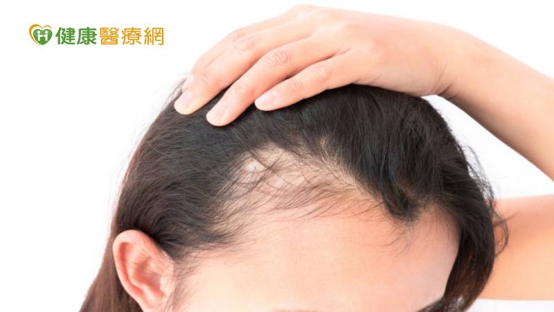 「雄性禿」不只男性有! 醫揪:恐怕是「這些原因」惹禍