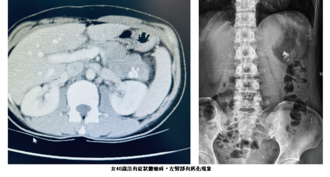「再忙也要記得健檢」不要讓良性胰臟腫瘤轉變為惡性胰臟癌！