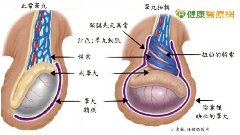 蔡伊達醫師表示,鞘膜先天異常者,較易發生睪丸扭轉